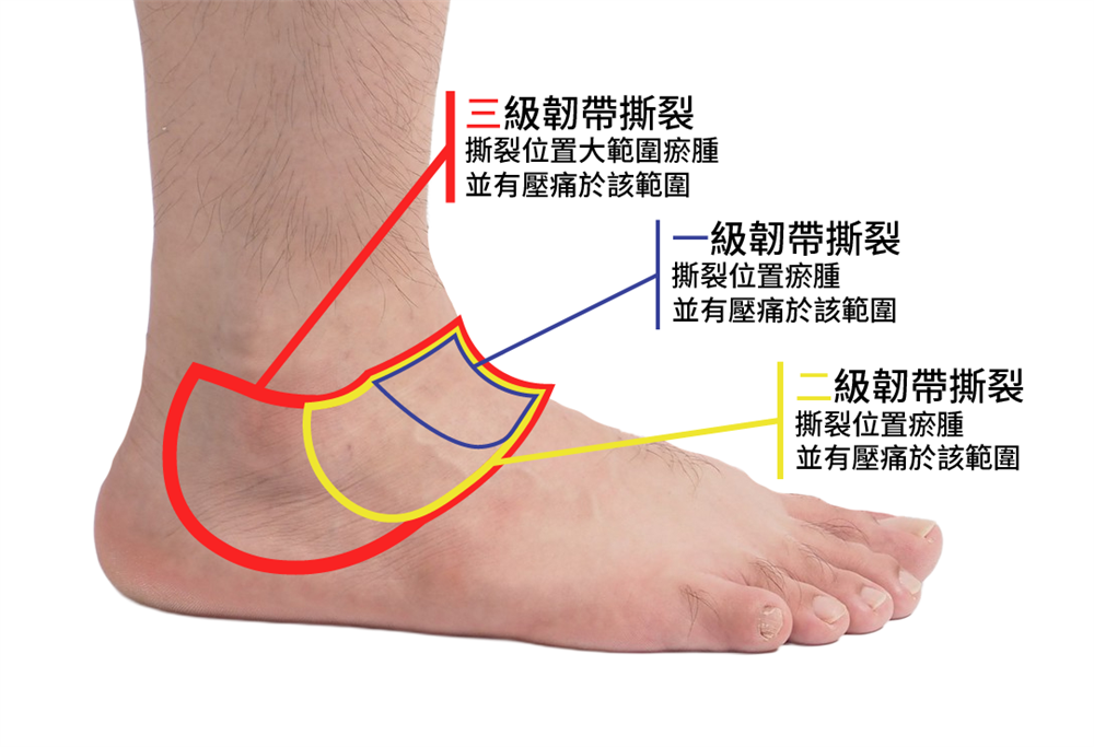拗柴分級